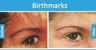 Birthmark removal