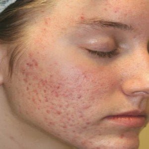 Hyperpigmentation, Laser and Chemical Peel Therapy