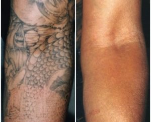 Tattoo removal, Techniques, Results, Recovery and Guidelines 