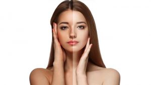 Tan removal In Delhi, Laser Treatment, Risk, and Preparation