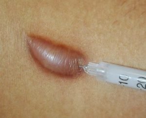 Keloid Scar, Symptoms, Causes, And Treatments