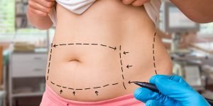 Mesotherapy and Liposuction Best Ways To Reduce Weight Fast