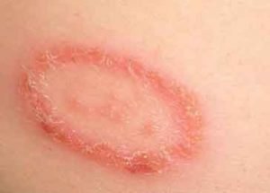 Skin fungal infections, Causes, Types, and Treatment