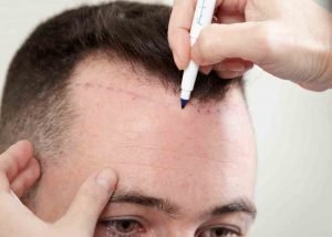 Hair Transplant Treatment Questions and Answers