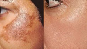 Dark Spot Removal