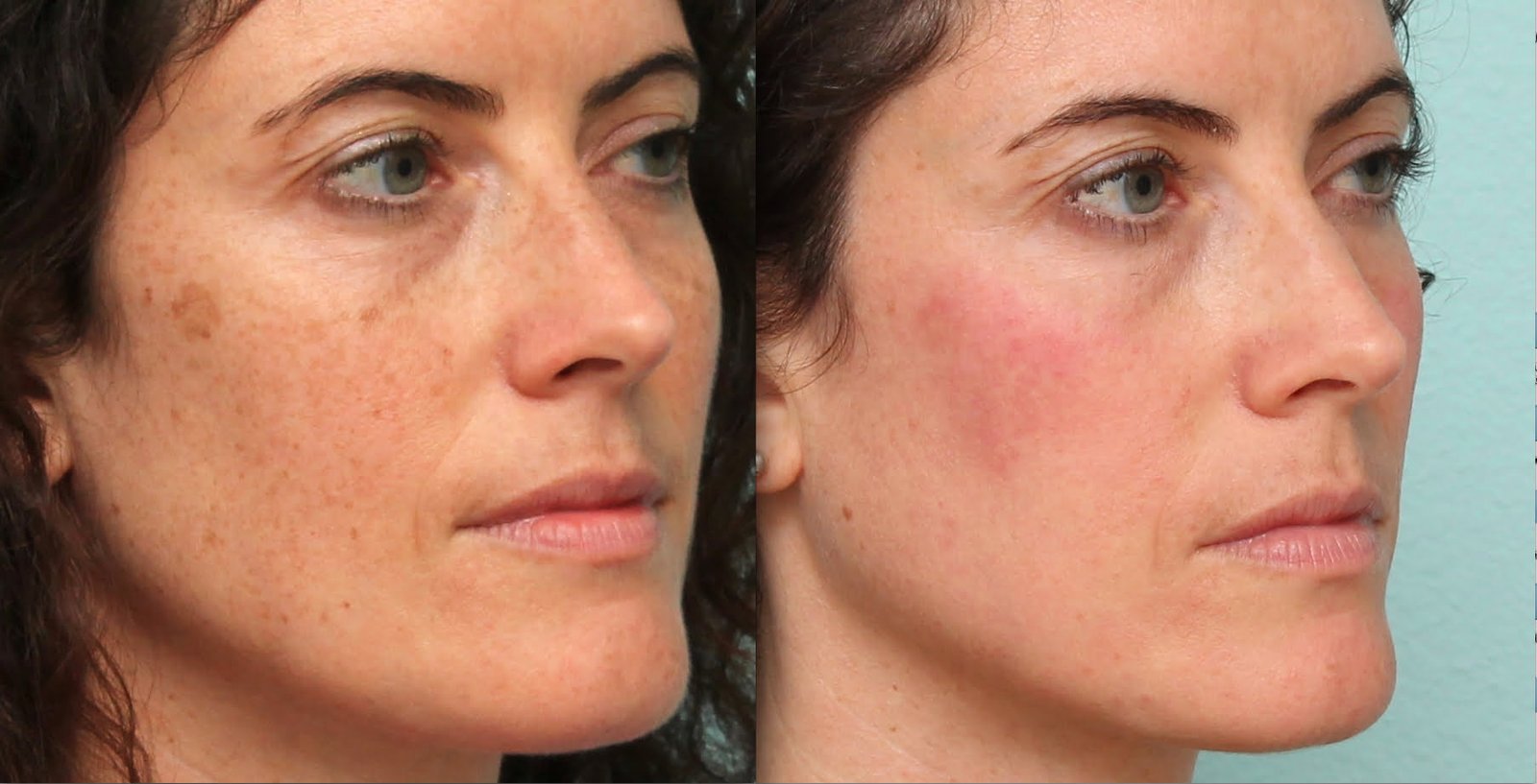 Diminish facial spots permanently