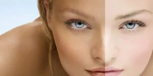 Skin Whitening Treatment Procedure Benefits and Cost