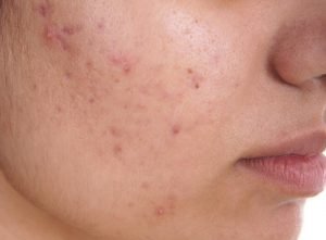 Acne Removal Question And Answer