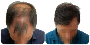 FUE Hair Transplant Procedure, Advantages, and Cost