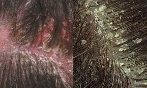  Oily Scalp Treatment in Delhi