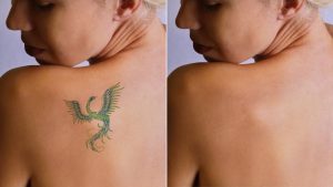 Tattoo Removal Recovery