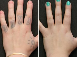 Tattoo Removal Recovery, Tips for Better Result