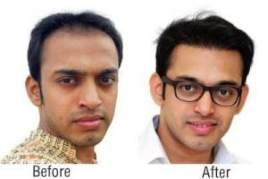 Hair Transplant Question and Answer