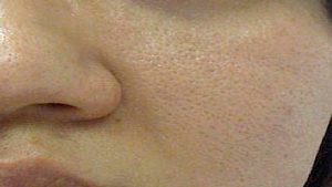 Large pores