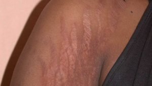 Stretch Marks Removal Question And Answer
