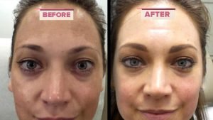 Melasma Treatment Question And Answer