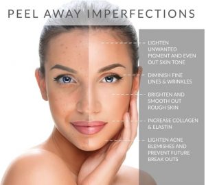 Chemical Peel Treatment And Its Types