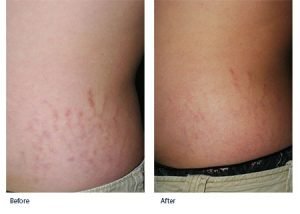 Laser Stretch Marks Removal Best Treatment