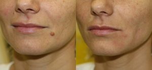 Moles Removal Causes and Best Treatment Options