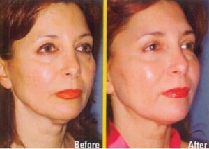 Thread facelift Procedure, Myths and Facts