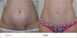 Laser Stretch Marks Removal Best Treatment