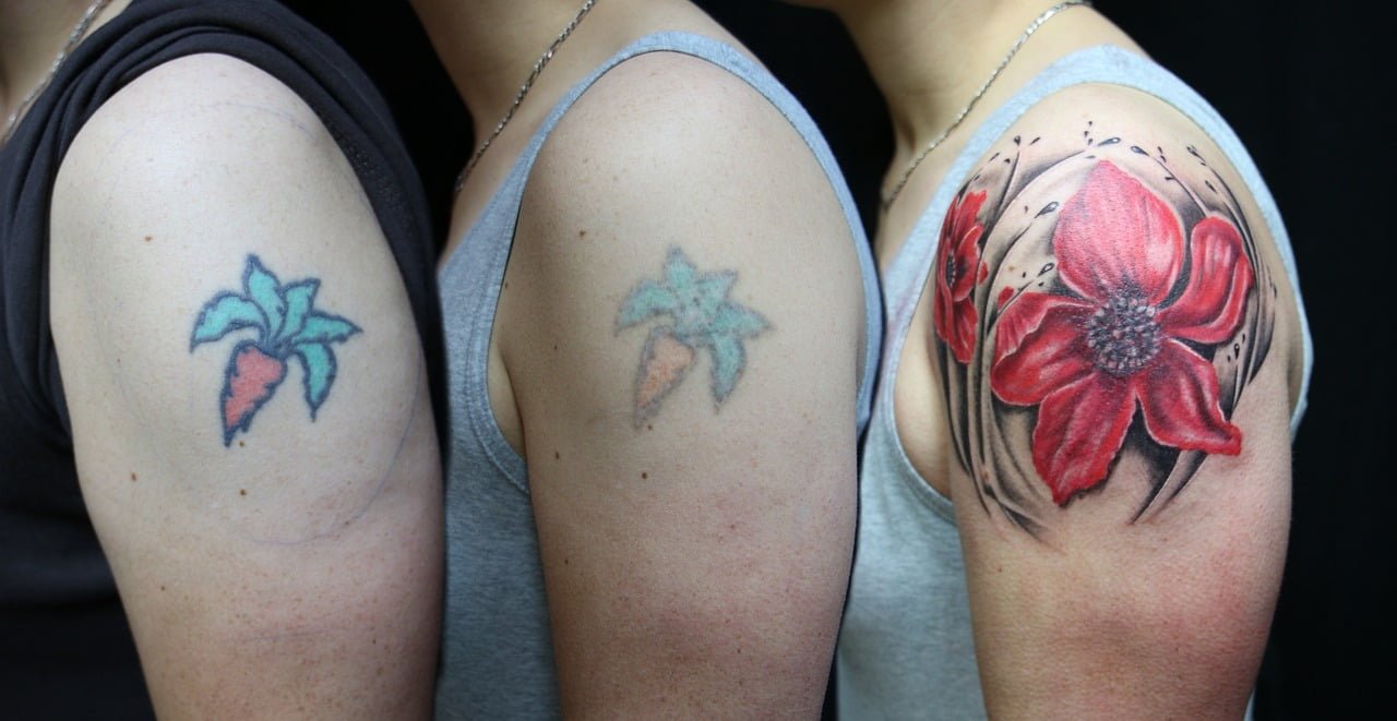 Best Laser Tattoo Removal Treatment in Gurgaon, Permanent Tattoo Removal in Gurugram