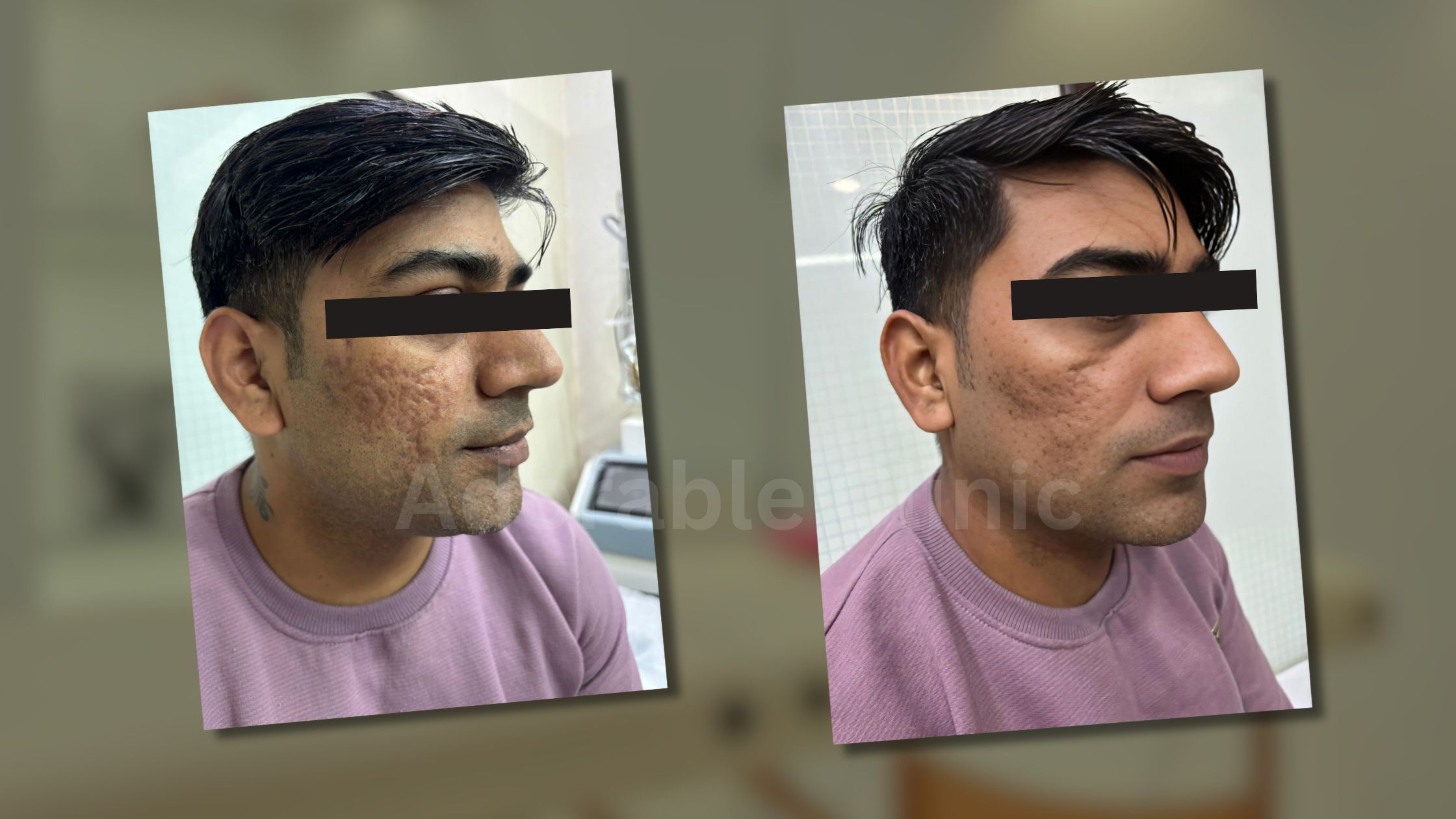 Acne Scar Removal Treatment In Delhi Laser Acne Scar Treatment In Delhi