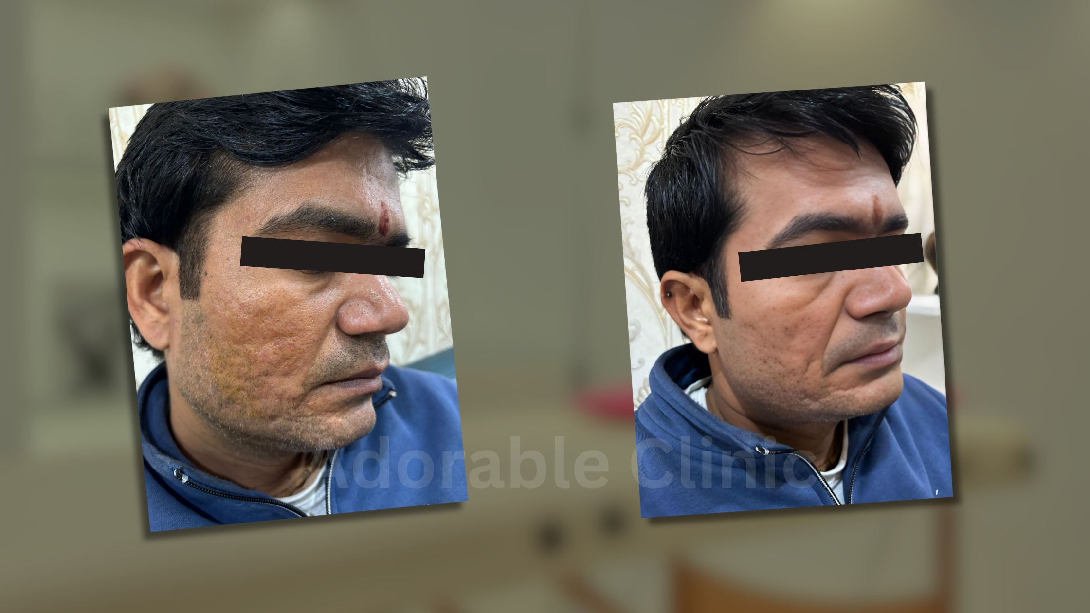 Laser scar removal treatment being performed at Adorable Clinic in Delhi