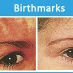 Birthmark removal