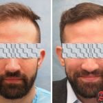Best Hair Transplant Clinic Delhi Before after results