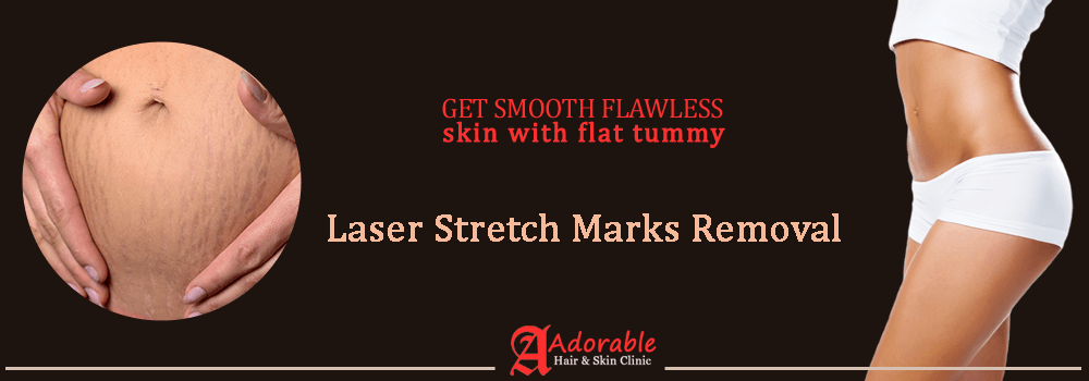 best stretch marks removal in delhi (1)