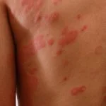 Eczema Laser Treatment, Causes, Risk, and Side Effects