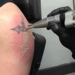 Tattoo removal, Techniques, Results, Recovery and Guidelines