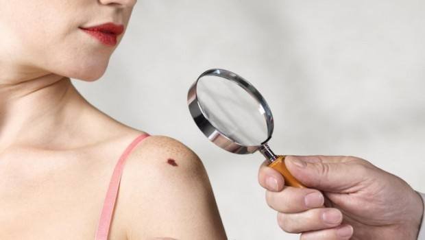 Mole Removal in Delhi, Best results, Procedure and Cost.