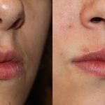 Mole Removal in Delhi, Best results, Procedure and Cost.