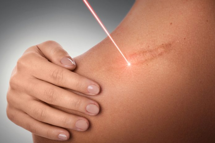 Scar-removal laser
