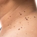Skin Tags, Wart, Moles, Removal in Delhi, Laser Procedure