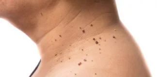 Skin Tags, Wart, Moles, Removal in Delhi, Laser Procedure