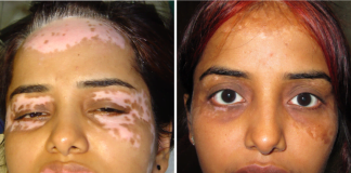 Vitiligo Treatment in Delhi, Procedure, and Post-Guidelines
