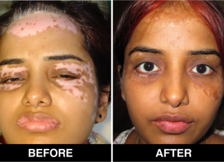 Vitiligo Treatment in Delhi, Procedure, and Post-Guidelines