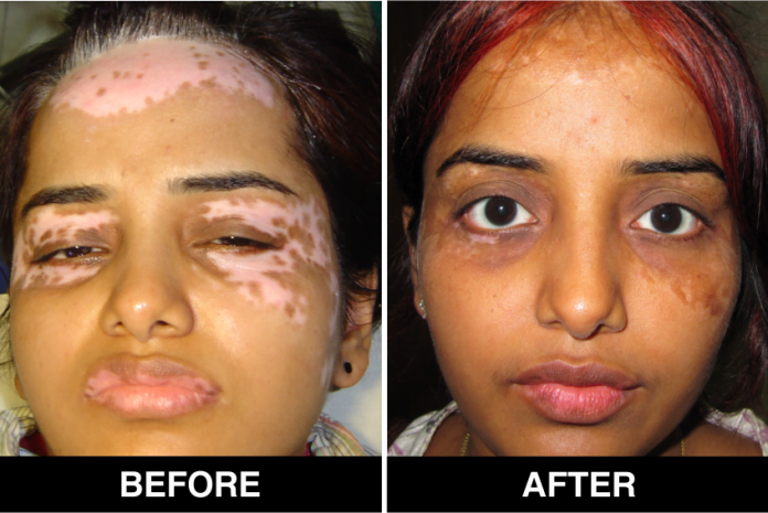 Vitiligo Treatment in Delhi, Procedure, and Post-Guidelines Vitiligo Treatment in Delhi, Procedure, and Post-Guidelines