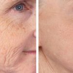 Non-Surgical Anti-Aging Laser Treatments In Delhi