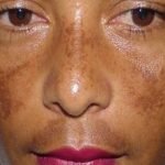 Melasma Treatment in Delhi, Advantages of Laser therapy