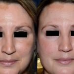 Melasma Treatment in Delhi, Advantages of Laser therapy