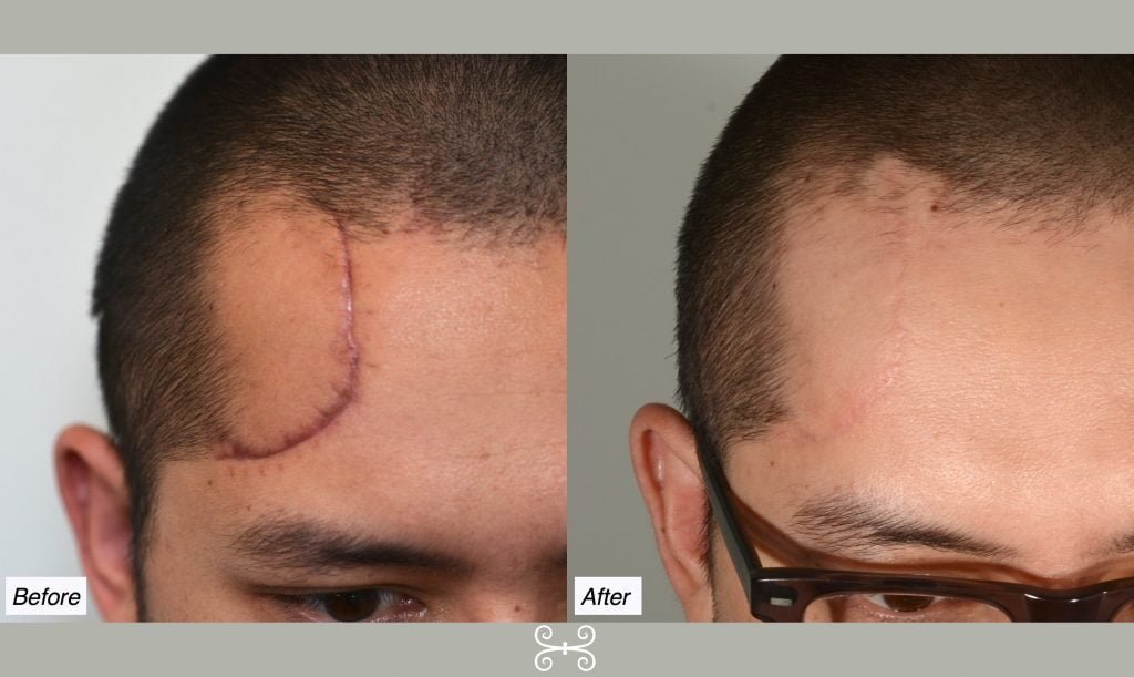 Scar Removal In Delhi, Process, Guidelines, Recovery, Result