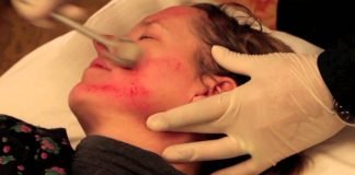 Derma roller Procedure, Recovery, Post Guidelines, and Benefits