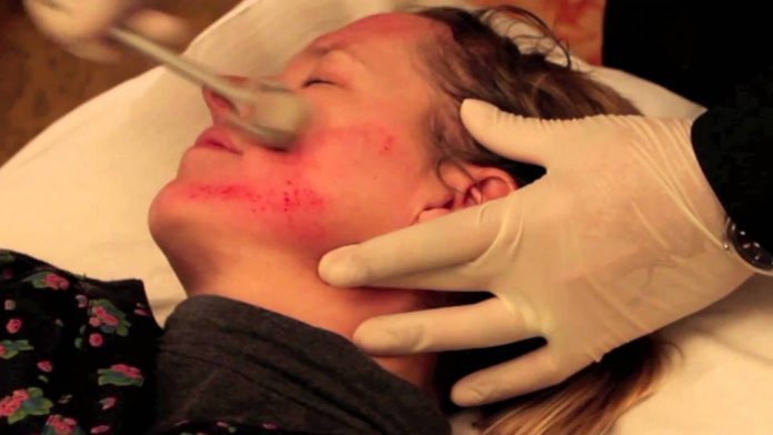 Derma roller Procedure, Recovery, Post Guidelines, and Benefits Derma roller Procedure, Recovery, Post Guidelines, and Benefits