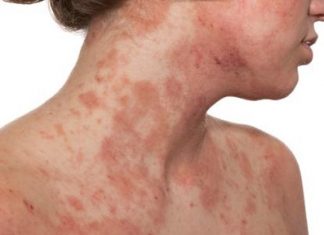 What Is Dermatitis? Symptoms, Treatment, and Prevention