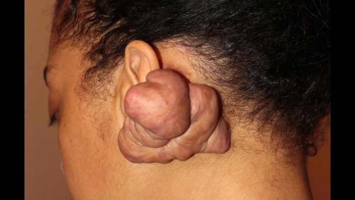 Keloid Scar, Symptoms, Causes, And Treatments Keloid Scar, Symptoms, Causes, And Treatments