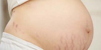 Pregnancy Stretch Marks Removal, Causes, Symptoms, and Treatment